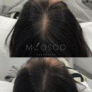 무수 | 강남두피문신으로 자연스러운 변화를 원했던 강남두피문신 무수 청담 후기