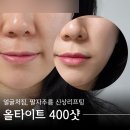 신사역 처진 얼굴 리프팅 : 다운타임 없는 올타이트 400샷 일주일 후기