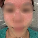 (주)필메드 | 25년결혼준비: 본식전 윤곽피부관리 샤넬주사 필메드135 필로르가 가격 및 부작용 효과 후기