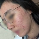 (혐오주의)여자 만성여드름 없애는 법 : 중학교 사춘기부터 30대 초반까지 지긋지긋한 여드름이랑 이별...