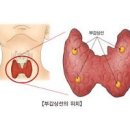 부갑상선 기능항진증 기능저하증 증상 (칼슘 인 많은 음식) 이미지