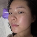 피코토닝 레이저 가격 장희빈미안법이 아껴준 후기