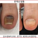 내성발톱발톱무좀관리김수정뷰티 이미지