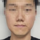 운현약국 | 사랑니 발치 리얼 후기 : 발치 전문병원 《사랑이아프니》 강추