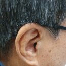 울림숲난청연구소 보청기 | 안양 평촌역 스타키 보청기로 이명까지 잡은 울림숲 난청 연구소 고막형 보청기