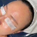 11215-자양2-379 | 좁쌀여드름 관리후기 구의역피부관리 스킨스튜디오