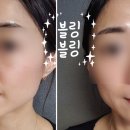거꾸로 나이 인셀덤 | 천안 인셀덤 피부관리 현정인셀덤 제품 사용 후기 ♪