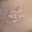 보인한의원 | 노원역 피부과 추천 피부관리 한의원 새살침 6회차 완주 후기