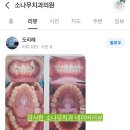 구개들 | 김포치과 고촌 소나무치과 -파인원 치주교정이야기2 -청소년 비발치 교정 /급속구개확장장치 후 교정 후기