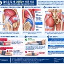 옆으로 누워 잘 때 고관절이 아픈 이유｜둔근건병증과 대전자통증증후군 재활 이미지
