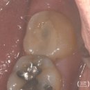 K&K서울치과의원 | [서초 방배 시크릿치과]여기는 하와이;"밥 먹다가 이가 깨져 나왔어요"; K-dental 최고!