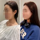 청담피부과 압구정 울쎄라 프라임 내돈내산 받으러 간 후기 (통증 /붓기/ 전후사진있음)