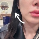 장산한의원 | 해운대 장산역피부과 심부볼제거 울쎄라 리프팅 300샷 후기, 유지기간