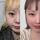 이뻐지는산책 | 둥근 이마 셀카찍기가 행복해요💕강남역 이마/풀페이스 필러 리얼후기!