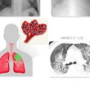 폐에 물이 차는 이유와 물이 차면 나타나는 증상 : 폐부종 이미지