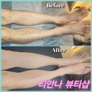 양지산부인과의원 | 티안나 다리 왁싱 후기 #군산왁싱 #군산왁싱잘하는곳 #군산브라질리언왁싱