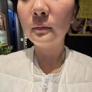 더미스 | 범계역 피부과 처진 얼굴 심부볼 즉각 해결 올타이트리프팅 후기