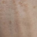 남진한의원 | 목 편평사마귀 모두 없애는 멀티에멀젼으로 자신있게 피부관리