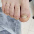 레푸스인천부평씨지브이(CGV)점 | 부평 발톱무좀 [레푸스부평CGV점] 점점 나아지는 발