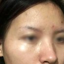 참튼튼약국 | 피부 색소침착 연고 약국 처방 사용후기 피부재생 효과 성분 부작용