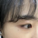 대구 동성로 눈밑필러 앞광대필러 맛집 <하이린의원>