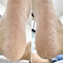 건조하고 갈라진 엄마발 뒤꿈치, 딸이 예약해준 민락동 발각질 관리 후기