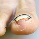 타임네일 페디베네 이미지