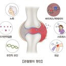 골관절염(Osteoarthritis) 이미지