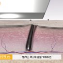 리마인드피부과의원 네이버블로그