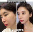 숲안에 스킨 | 서울숲역피부과 셀리비온 린제이 리투오계열 스킨부스터 효과 후기