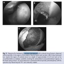 Arthroscopy for the Treatment of Femoroacetabular Impingement in the Athlete(관절경 사진) 이미지