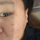 [대전 서구] 둔산동에스테틱 지니뷰티샵 여드름관리 후기