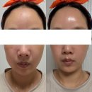 포레시스 | 더마아키텍트 솔직 후기 — 피부과 안 가도 되는 이유 있었네요