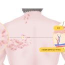 📌 대상포진 증상부터 예방접종 후기까지!