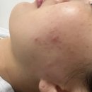 청솔한의원 | 대구수성구피부관리 ㅣ 여드름관리 콜라즈마 후기 유스에스테틱 황금점