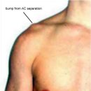 봉우리빗장관절(견쇄관절.ronic AC joint dislocation preoperative shoulder examination)탈구검사 동영상 이미지