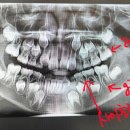 8세아이 교정, 충치의견 부탁드려요 이미지