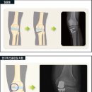 등산과 무릎에 관하여..(제 2부) 무릎관절 보호의 ABC 이미지