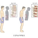 강직성 척추염 이미지