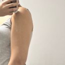 (주)온바이블 | 홍대입구역 피부과 팔뚝 지방파괴주사 바이블주 2주차 윤곽주사 후기