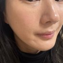 멍요일 | 연신내 피부과 쥬베룩 스킨부스트 멍, 엠보, 통증 요일별 후기