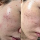 아진일렉트론3공장 | [W_03] 웨딩촬영 전 피부관리 feat.주사피부염 현재 근황일기 분노의 염증주사