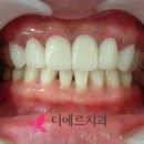 스마일 라인 치과기공소 이미지