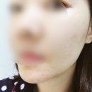 스킨룩스한의원 | 주사피부염 치료 후기 (진행중) 스킨룩스 한의원 1탄