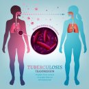 결핵 (Tuberculosis, TB) 이미지