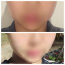 신논현피부과 슈링크유니버스 300샷 볼살리프팅 내돈내산 후기