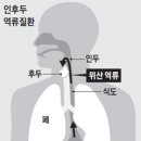 목 이물감·헛기침, 위산 역류(인후두 역류질환) 탓일 수도 이미지