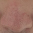 진성레이져 | 구진성흉터·비후성반흔 레이저 시술 치료과정(3~4회)