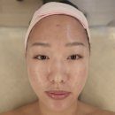 율한의원 | (여드름흉터) 천안 여드름전문 한의원 마지막 율각테라피(총3회) + 부분 새살약침(총3회) 찐후기