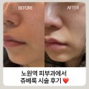 노원역 8번출구 | 노원역피부과 추천 ㅣ 스킨부스터 쥬베룩스킨 내돈내산 시술 직후 ~ 7일차 무보정 찐 후기